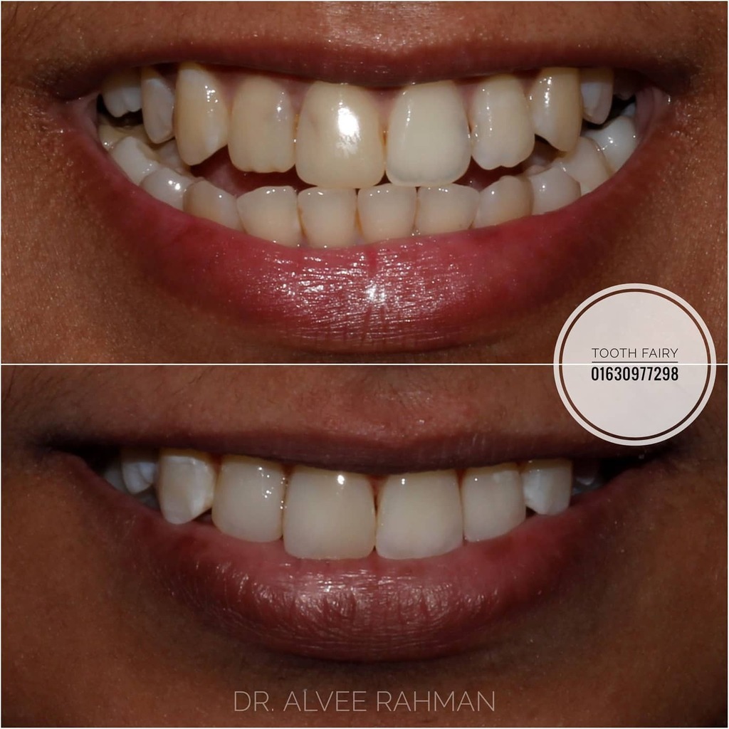 _Alvee's tweet image. #smilemakeover with #direct_composite_veneer. #dental #dralvee #smile #toothfairy instagr.am/p/CJZVYHunvPz/