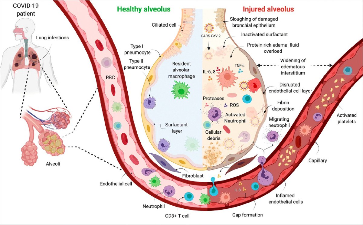 6/Loss of these alveolar cells results in alveolar instability, lung flooding, and respiratory failure - Acute Respiratory Distress Syndrome (ARDS). ARDS causes further damage through a hyperactive immune response of neutrophils and cytokines that damage alveoli even more. 6/7
