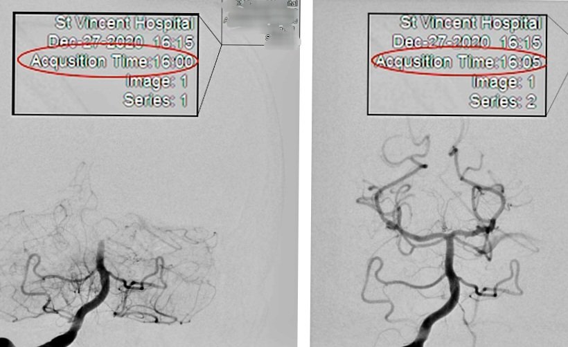 almuftifawaz's tweet image. That has got to be an #Indianapolis record. 4 minute TICI 3 recan! Terrific job @AmuluruKrishna 
#UpAgainAfterStroke #noLVOleftbehind #GTFVO