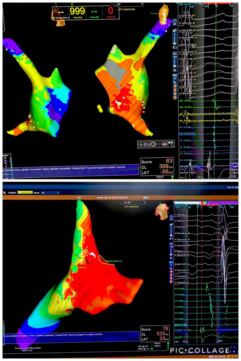 HighPwrShortGal's tweet image. Must be the week for AT’s! Yesterday, had one septal near TVA. Today had one up close to the sinus node. #HDgrid made quick work of both at nailing down a spot with beautiful unis. #TCSE in for the one burn terms. @AbbottCardio #mapmoreburnless @Scott22957 @Segarspr