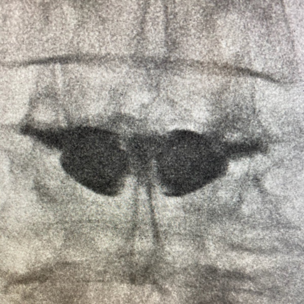 Miriam_Peckham's tweet photo. There’s a lot I like about the #SpineJack system.
1: More consistent height restoration
2: Better control of cement dispersion
3: And of course, the fact that the finished product looks very similar to my favorite emoji 😎
#UofUSpine #spine #neurorad https://t.co/3o7lNxvrU3