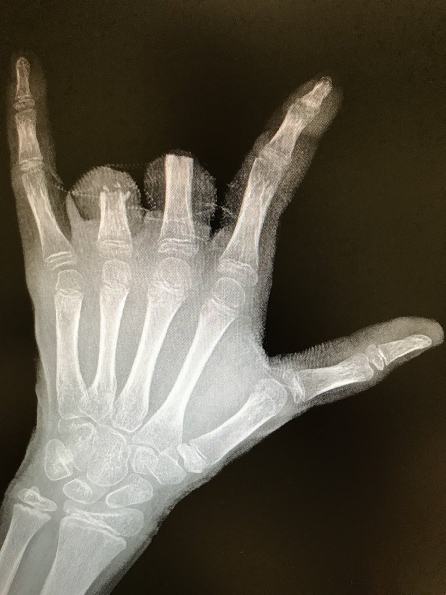 Rescato este caso para sensibilizar acerca del uso de petardos 🧨, sobre todo en niños. En mi opinión, deberían estar prohibidos.