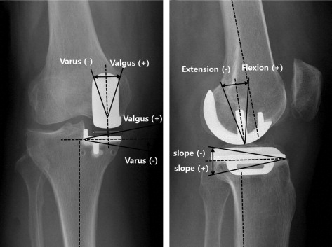 BoneJointJ's tweet photo. 🎄#12DaysofOrtho🎄
On the 6th day of Ortho BJJ gave to me six knee papers by @bjjeditor et al
Check them out for #FREE: https://t.co/eyHsl2AiUa
#orthotwitter #kneereplacement #kneesurgery https://t.co/mgenR5mAY1