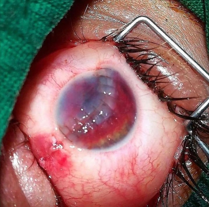 ItMedicalvid's tweet photo. Penetrating trauma to the open eyeball before and after surgery.🔥👋 https://t.co/q9YP1i5sl2