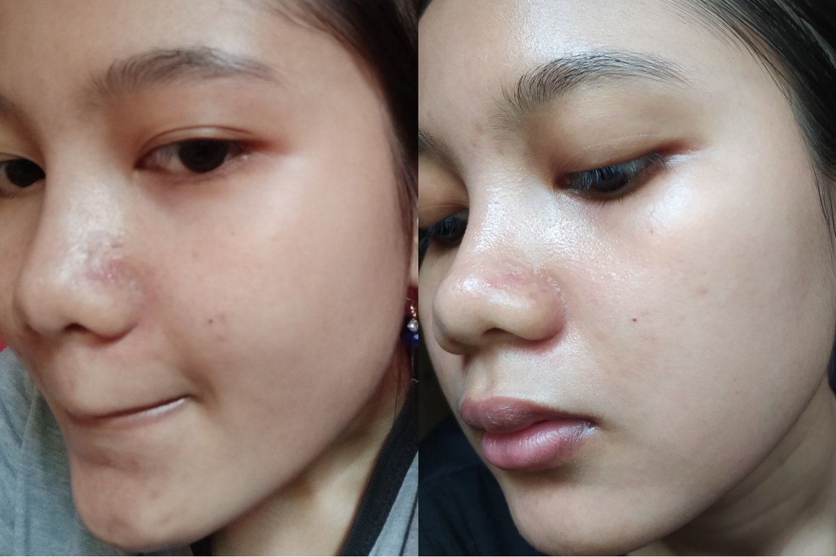 kulitku cuma berjewat satu dua dan lepas dr lbc pun ga breakout parah gitu, karna aku belum terlalu paham skincare waktu itu jd aku coba sana sini dan berakhir breakout kaya difoto, nah anehnya lg pasti selalu pipi kanan yg muncul jerawat, pipi kiri itu bersih kaya gini