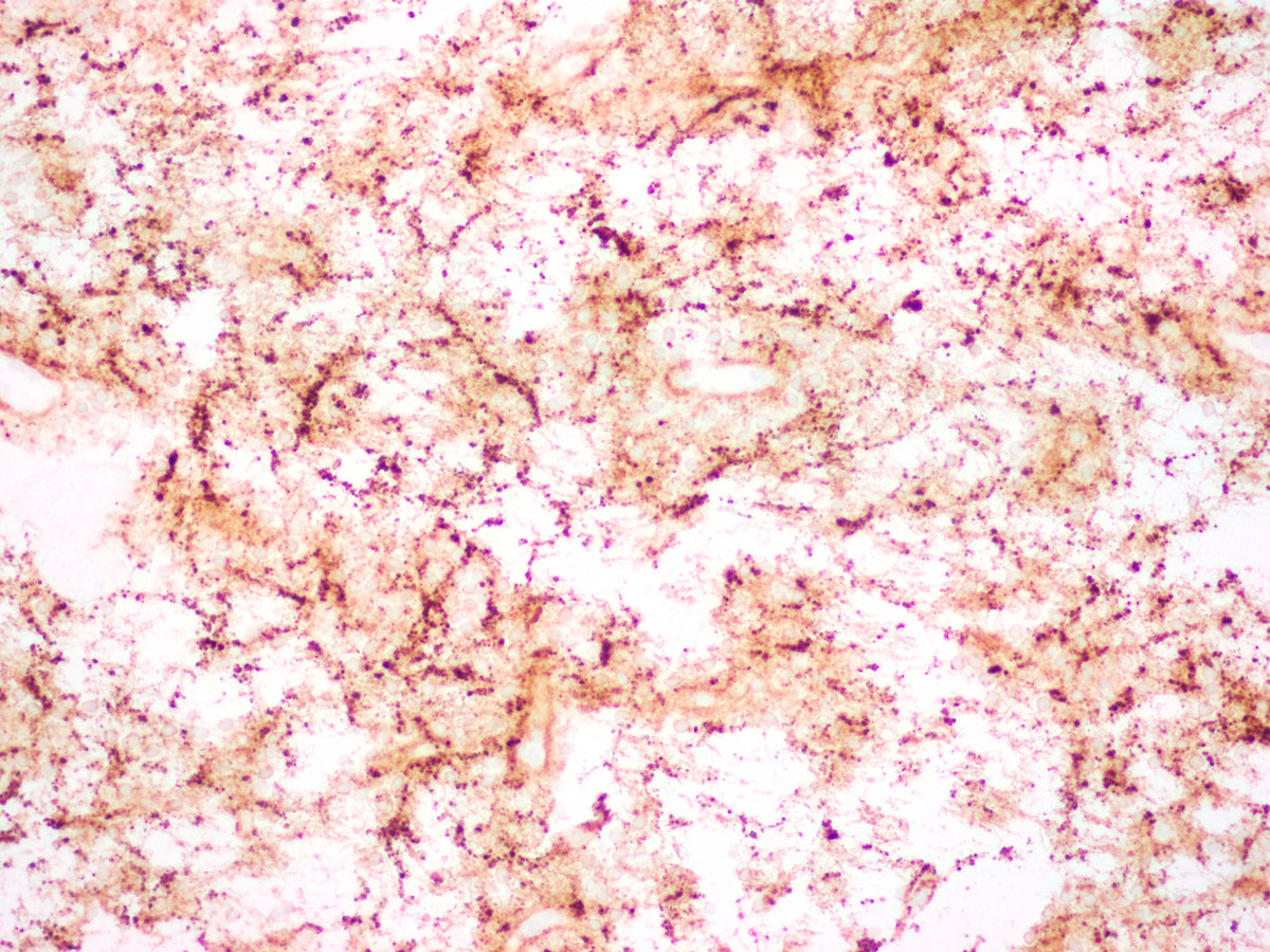 Myxoid Glioneuronal Tumor, PDGFRA p.K385 mutant in the septum pellucidum of a teenage boy. Originally described by David Solomon and colleagues @UCSF_PBC (PMID: 31609499). Coming soon to WHO Edition 5! #neuropath #braintumor