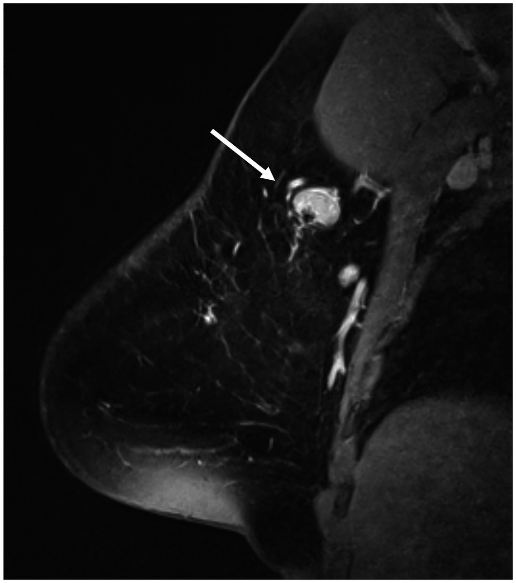 CA: A Cancer Journal for Clinicians (@cacancerjournal) on Twitter photo Revisit our Virtual Tumor Board on multidisciplinary considerations in the treatment of triple-negative #breastcancer by <a href="/TariKingMD/">Tari King MD</a> includes chemotherapy, surgical, RT, and #PatientAdvocacy perspectives. acsjournals.onlinelibrary.wiley.com/doi/full/10.33… <a href="/DanaFarber/">Dana-Farber</a> <a href="/harvardmed/">Harvard Medical School</a> <a href="/BrighamWomens/">Brigham and Women's Hospital</a> Revisit our Virtual Tumor Board on multidisciplinary considerations in the treatment of triple-negative #breastcancer by <a href="/TariKingMD/">Tari King MD</a> includes chemotherapy, surgical, RT, and #PatientAdvocacy perspectives. acsjournals.onlinelibrary.wiley.com/doi/full/10.33… <a href="/DanaFarber/">Dana-Farber</a> <a href="/harvardmed/">Harvard Medical School</a> <a href="/BrighamWomens/">Brigham and Women's Hospital</a>