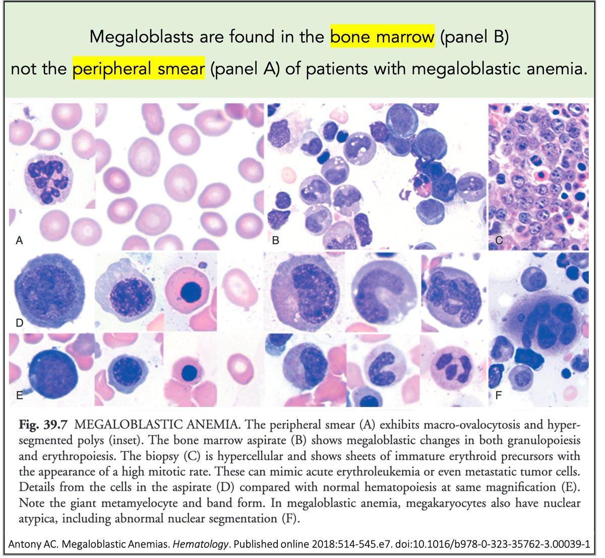 Megaloblastic Anemia Peripheral Smear