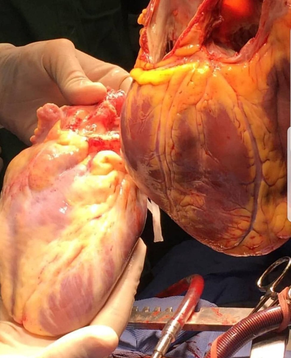 CardioSurgPost's tweet photo. The new and the old one. #cardiotwitter #MedTwitter #cardiosurgerypost #cardiactx #cardio https://t.co/w45AYuwGGG