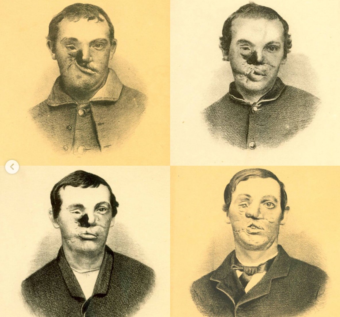 (4/8) With the help of a dentist named Thomas B. Gunning, Buck was able to reconstruct parts of Burgan’s face using rudimentary skin grafts and flap techniques. Images:  @medicalmuseum
