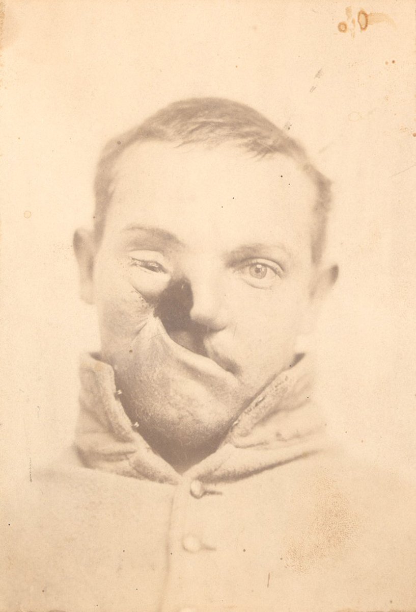 (3/8) The most skillful surgeon to emerge during this period was Gurdon Buck, who helped repair the face of Private Carleton Burgan after a gangrenous infection destroyed his upper mouth, palate, right cheek & eye. Photo: Science Photo Library.