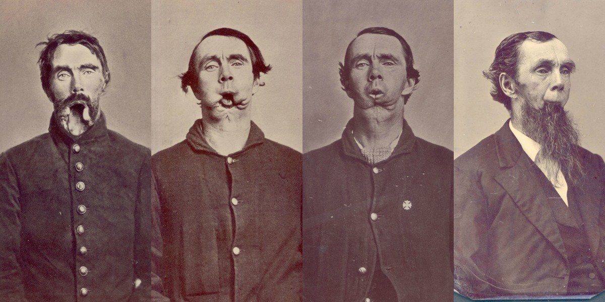 (1/8) THREADDuring the American Civil War, serious attempts were made to reconstruct the faces of soldiers injured in battle. Pictured here is Private Roland Ward, who underwent several operations without anesthetic to repair his face in the 1860s. Photo:  @CivilWarMed