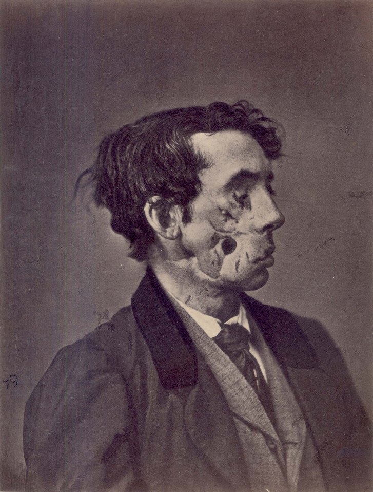 (6/8) Most soldiers injured during the Civil War were left with terrible wounds, gaps, and missing tissue in their faces. When Private Joseph Harvey was hit by a shell fragment, he found employment as a night watchman, and died shortly after.