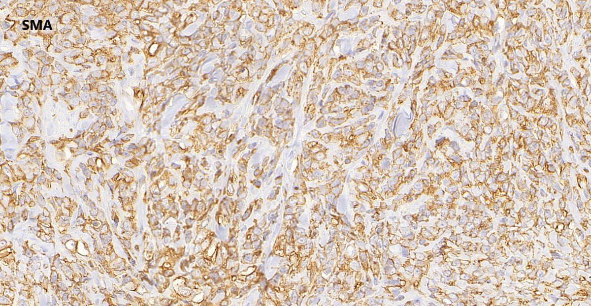ImmunohistochemistryPositiveCD34NegativeINI-1  (loss of staining)
