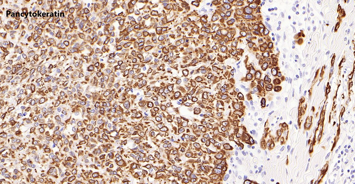 ImmunohistochemistryPositiveCD34NegativeINI-1  (loss of staining)