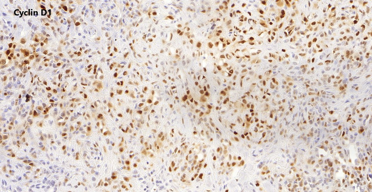 ImmunohistochemistryPositiveCD34NegativeINI-1  (loss of staining)