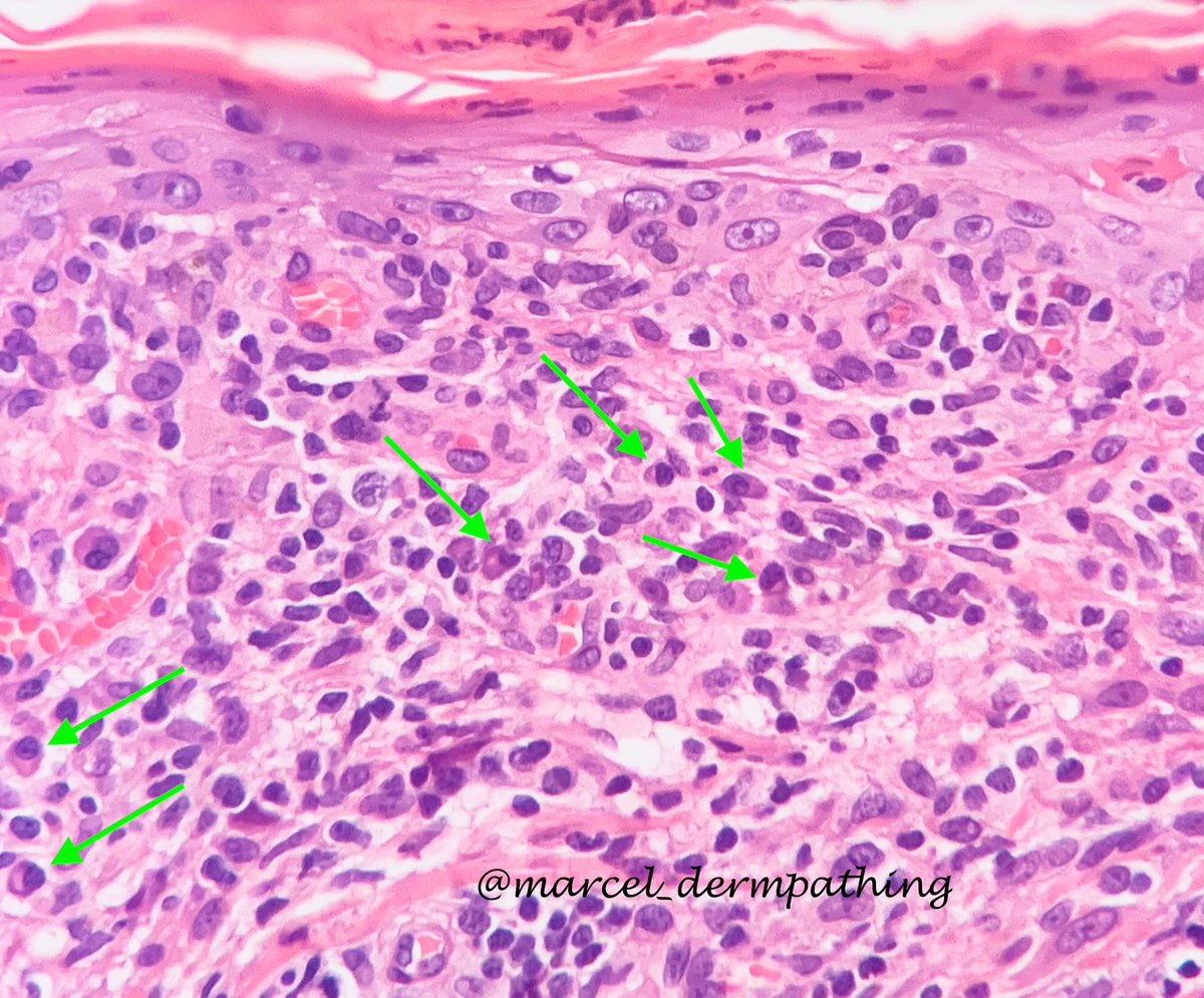 arakakiasato's tweet photo. Syphilis: lichenoid and “psoriasiform” dermatitis with many plasma cells. Immunohistochemestry can show the spirochetes. #dermatopathology #pathology #dermatology #syphilis #secondarysyphilis #spirochetes https://t.co/rvuFNzNujj