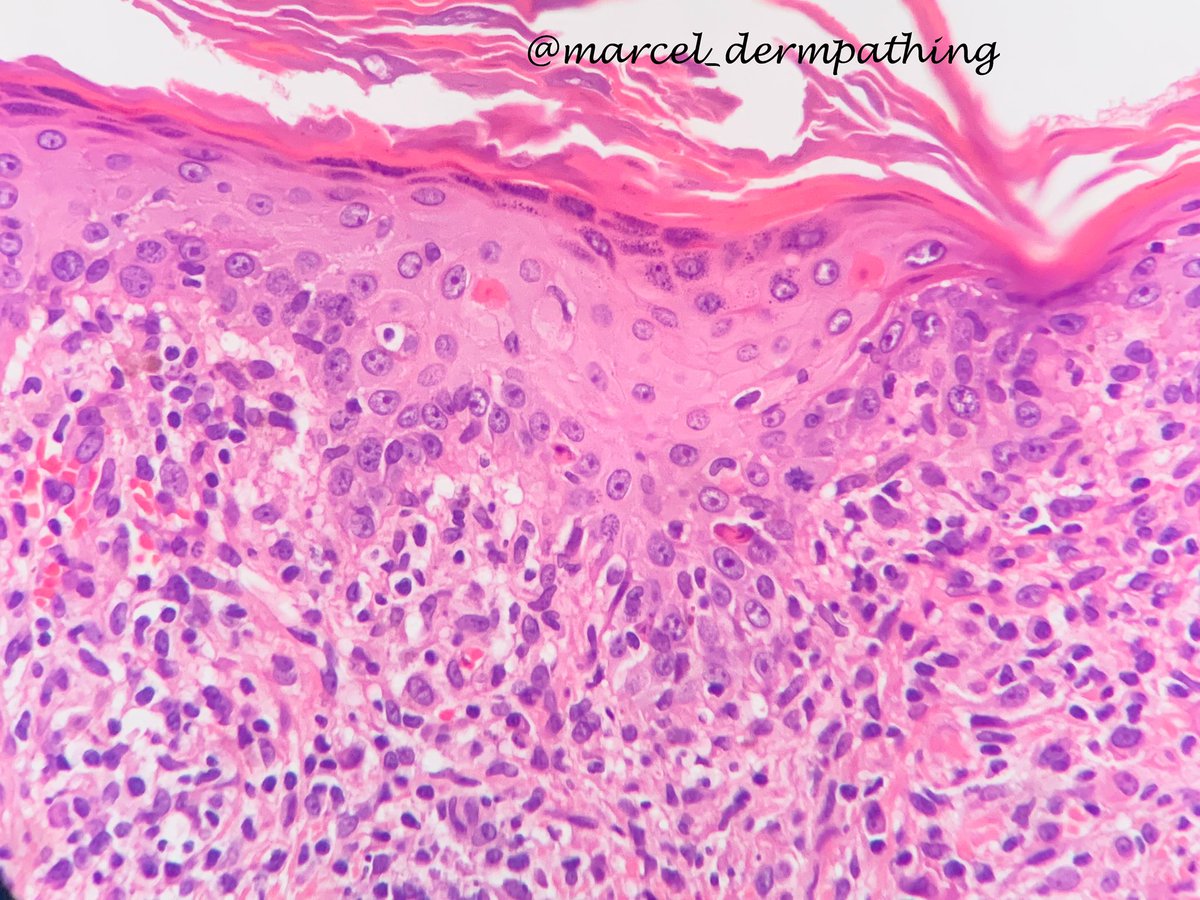 arakakiasato's tweet photo. Syphilis: lichenoid and “psoriasiform” dermatitis with many plasma cells. Immunohistochemestry can show the spirochetes. #dermatopathology #pathology #dermatology #syphilis #secondarysyphilis #spirochetes https://t.co/rvuFNzNujj