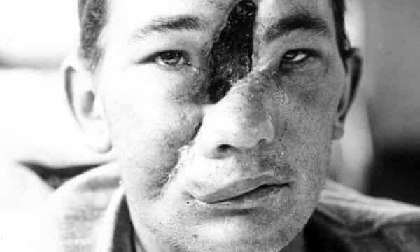 In World War I, we frequently had the phenomenon known as "Broken faces" that's because people would get hit with bullets or shrapnell and it would disfigure their face but not kill them.It was devastating for many of these veterans.Here is a before and after