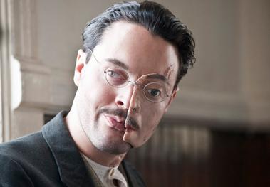 Yes. Richard Harrow in Boardwalk empire was an injured World War 1 vet with this phenomenon