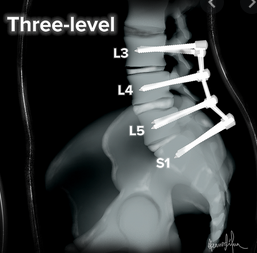I also used the lockdown as an opportunity to tackle my long-standing (or sitting!) issues with my back. and had another round of spinal fusion surgery in September: 3 operations in the space o 15 days. I'm not pain-free yet -- it'll take up to 18 months to fully fuse. (10/14)