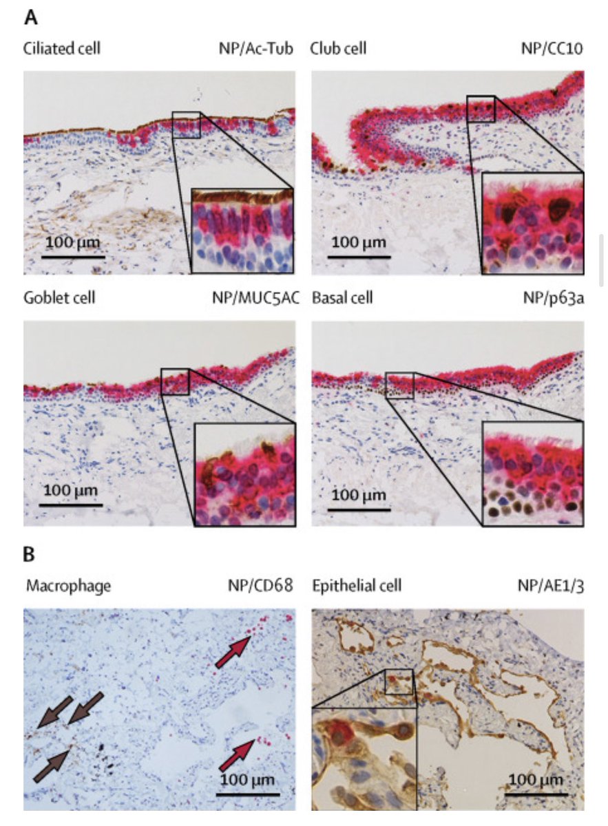 This extracts epithelial cells from patients respiratory tract and cultures those cells as a model for viral infection and replication.It has been done in C19 and I’m open to Koch Folks scrutinizing it’s short comings.