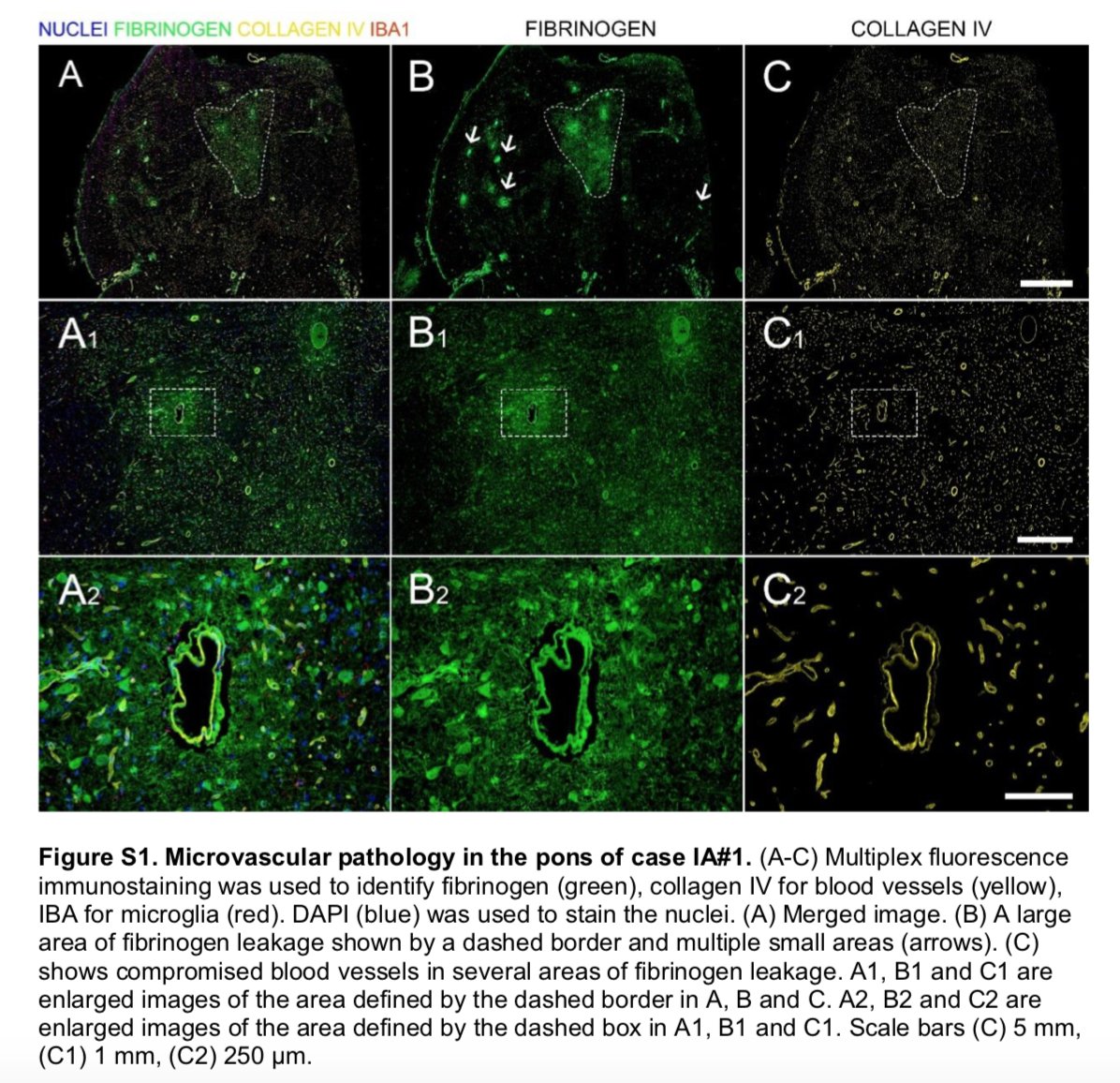7/ MR Microscopy (N=13)→ 9 = Punctate hyperintensities (areas of microvascular injury and fibrinogen leakage w/ corresponding features on histopathological exam w/ fluorescence imaging) → 5 = Thinning of basal lamina of endothelial cells by collagen IV immunostaining  #Covid