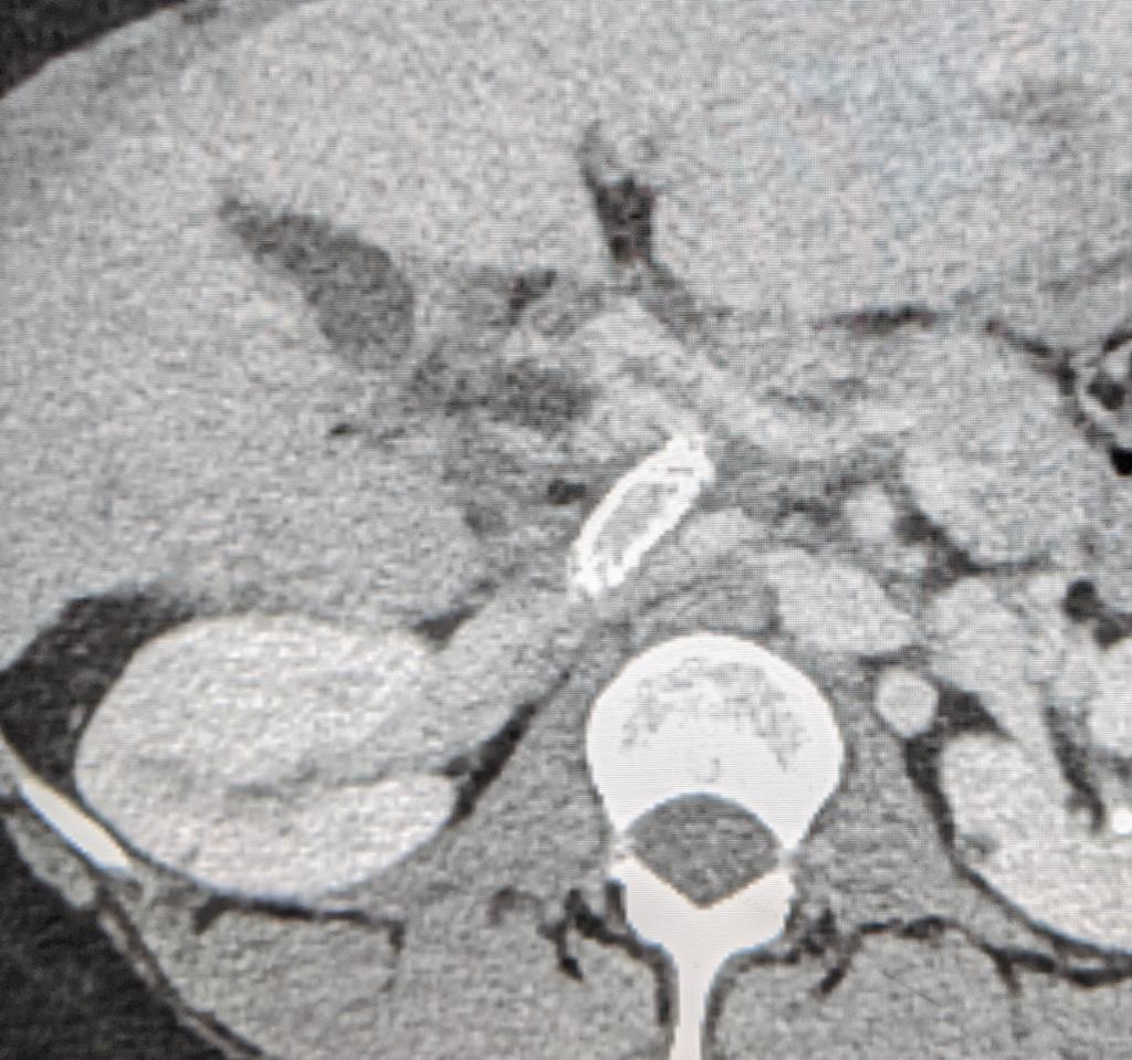 Mark Lessne, MD (@lessnevir) on Twitter photo Pt w failed TIPS, failed TIPS revision, portal occlusion w worsening sx
#Percutaneous #MesoCavalShunt w Transsplenic-assist, #gunsight technique
At F/up, sx resolved & pt excited to start new year!
#IRad <a href="/CLTRadiology/">Charlotte Radiology</a> @US_Rad <a href="/SIRspecialists/">Society of Interventional Radiology</a> <a href="/MountSinaiIR/">Mount Sinai IR</a> <a href="/JVIRmedia/">JVIR</a> Pt w failed TIPS, failed TIPS revision, portal occlusion w worsening sx
#Percutaneous #MesoCavalShunt w Transsplenic-assist, #gunsight technique
At F/up, sx resolved & pt excited to start new year!
#IRad <a href="/CLTRadiology/">Charlotte Radiology</a> @US_Rad <a href="/SIRspecialists/">Society of Interventional Radiology</a> <a href="/MountSinaiIR/">Mount Sinai IR</a> <a href="/JVIRmedia/">JVIR</a>
