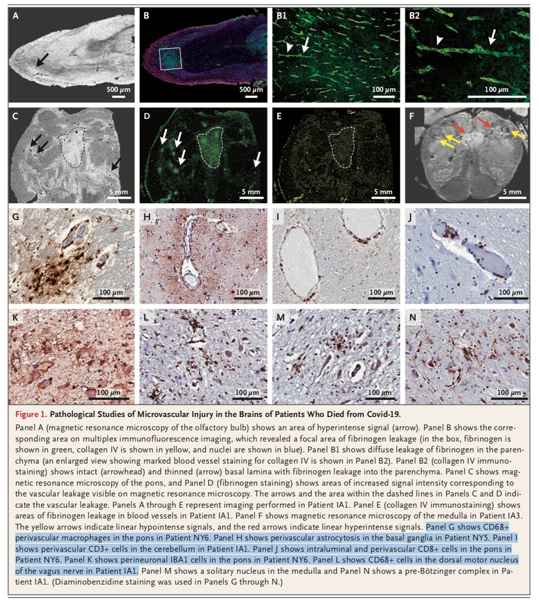 8/ → 10 = Punctate hypointensities on imaging corresponded to congested blood vessels with surrounding areas of fibrinogen leakage and relatively intact vasculature.*Areas of linear hypointensities were interpreted as microhemorrhages (a finding seen in other  #COVID autopsies)