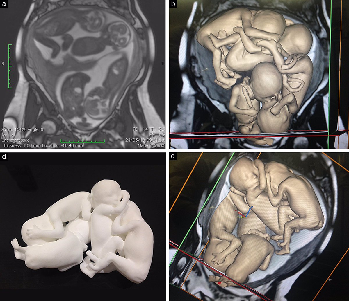 3D ultrason ve MR’da dördüz bebeklerin görünümü 👼👼👼👼

32 yaş, K, normal yolla gebe kalamayınca tüp bebek yöntemiyle sağlıklı dördüz bebek doğuruyor. Hepsi de hastaneden sağlıklı bir şekilde taburcu oluyor.