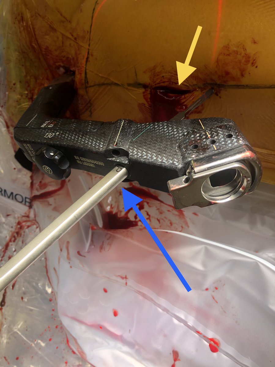 [16/18] Big Bird makes hole for distal screw sleeve(always lock distal!). Can measure off drill as enter far cortex(if plunge at 30, do 32). In large person/loose skin can put sleeve thru cephalic screw hole (yellow; stretch SKIN w/ArmyNavy & poke NEW hole in fascia w/ Big Bird).