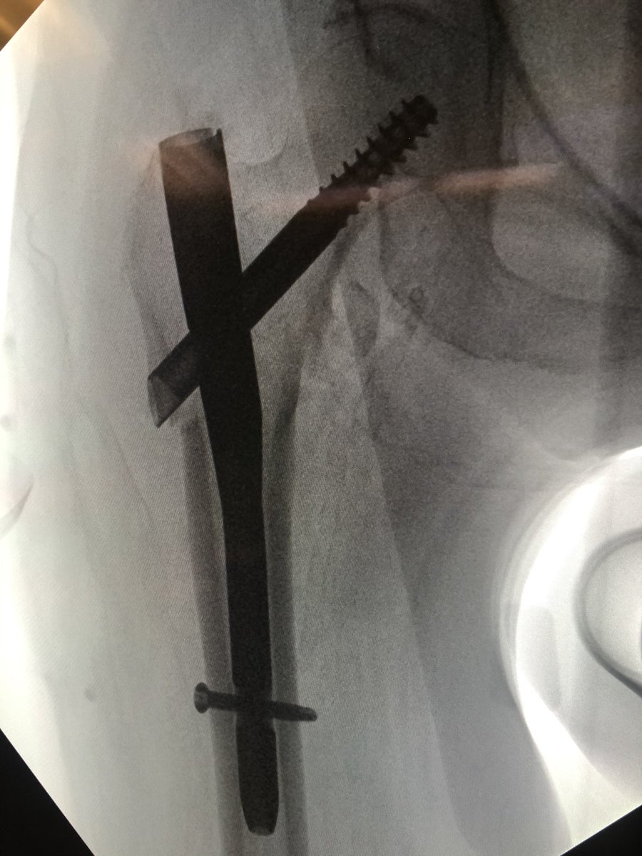 [18/18] The troch fragment is little abducted here, I don’t worry so much about screw being close to fracture line because nails don’t rely on lateral wall to work. Keep TAD (or calTAD as I do) small and most ITs heal without an issue. I also don’t use blades. Thanks for reading!
