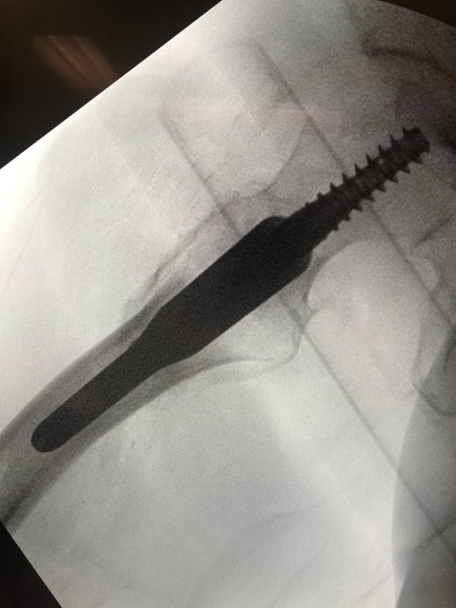 [18/18] The troch fragment is little abducted here, I don’t worry so much about screw being close to fracture line because nails don’t rely on lateral wall to work. Keep TAD (or calTAD as I do) small and most ITs heal without an issue. I also don’t use blades. Thanks for reading!