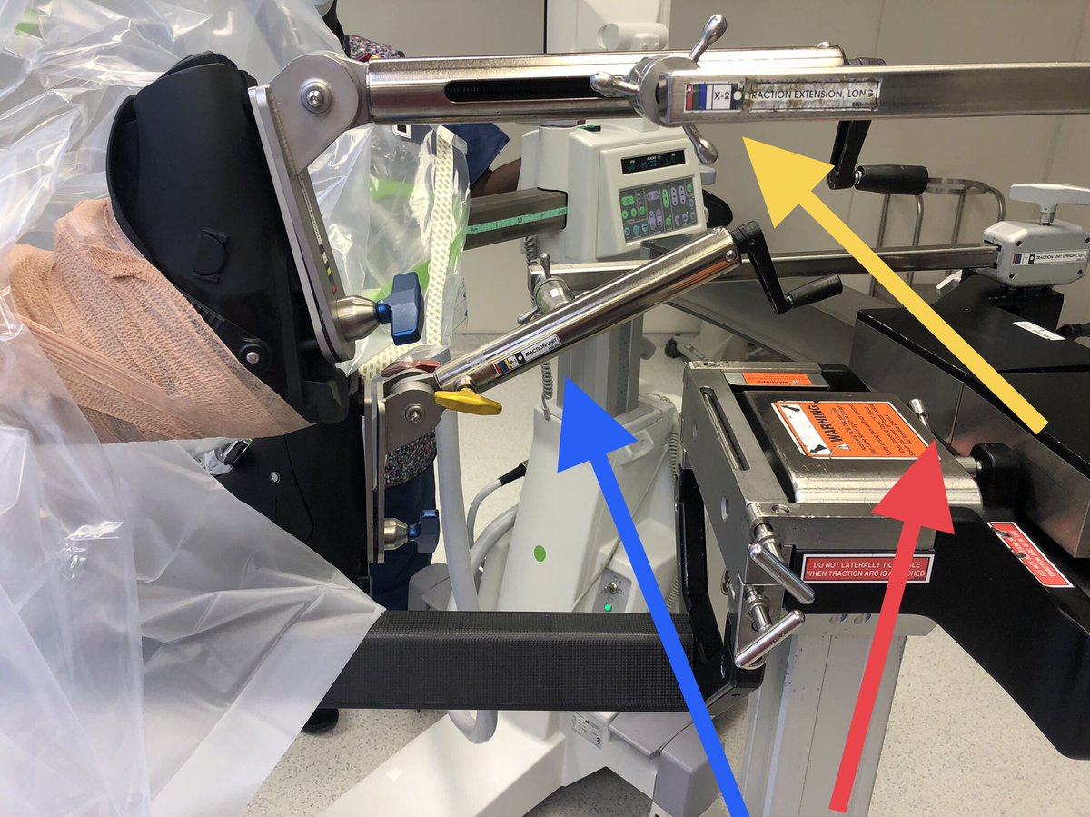 [2/18] If you don’t have table with overlapping legs like Hana (sigh), and have a limit to adduction (red), and don’t want to tape nonop leg to the bar or do lithotomy (I hate that position as can cause compartment syndrome), there are a few things you can do with fracture table.