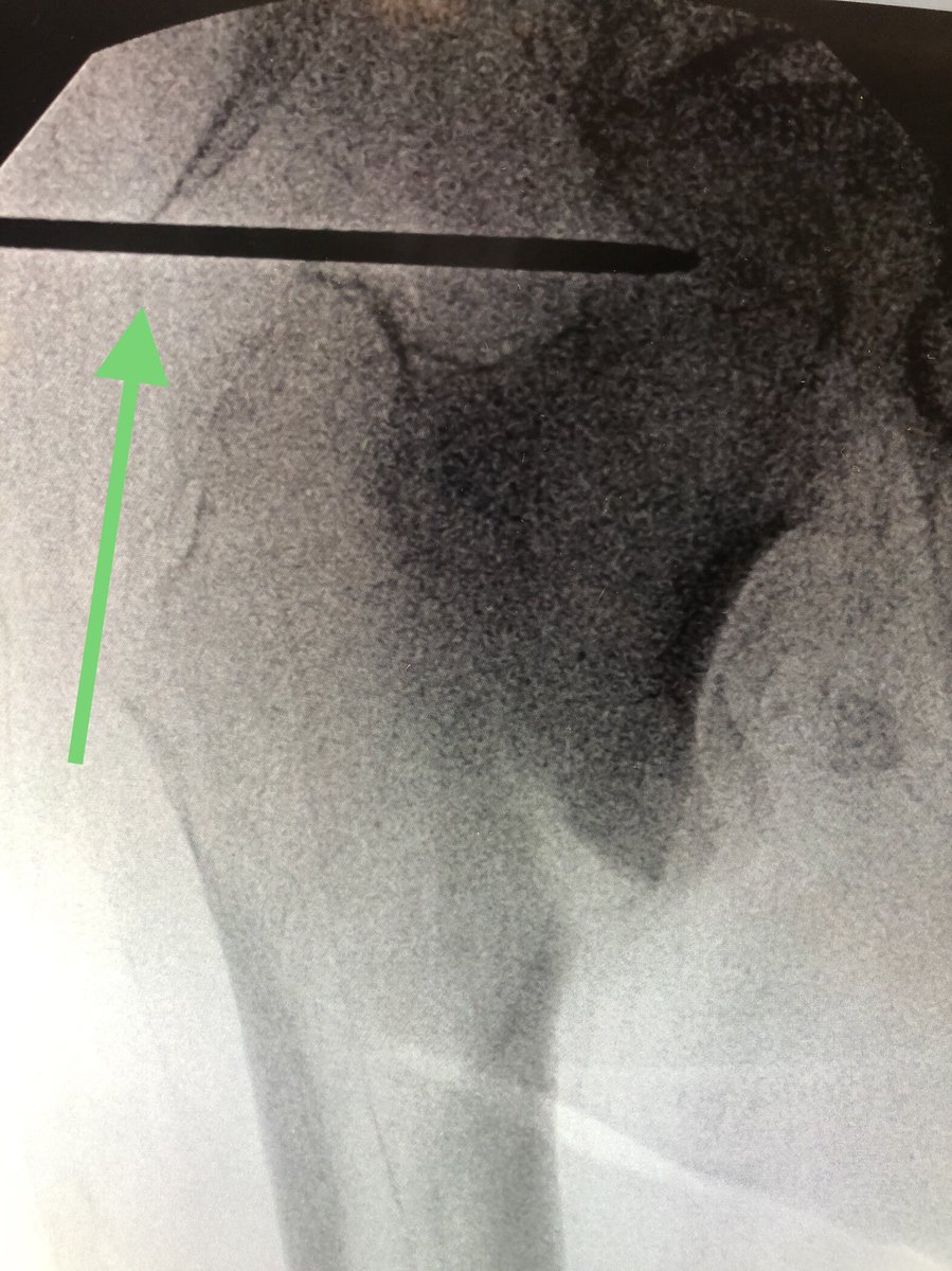 [5/18] Most important: starting point. I draw horizontal line on top of greater troch (green), and hold guidewire up to leg to line up with center of head/neck on perfect lateral & draw line (blue). Stab Incision about 4 finger-breadths proximal / 1 FB anterior to cross of lines.