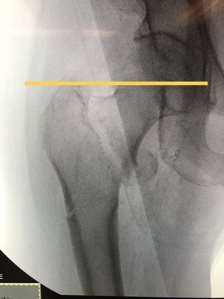 [4/18] The correct amount of traction, if you don’t want to judge by the other side, is usually close when greater trochanter lines up w/center of femoral head (yellow). You can play around with it and see how it looks. Can also always clamp if traction alone isn’t good enough.