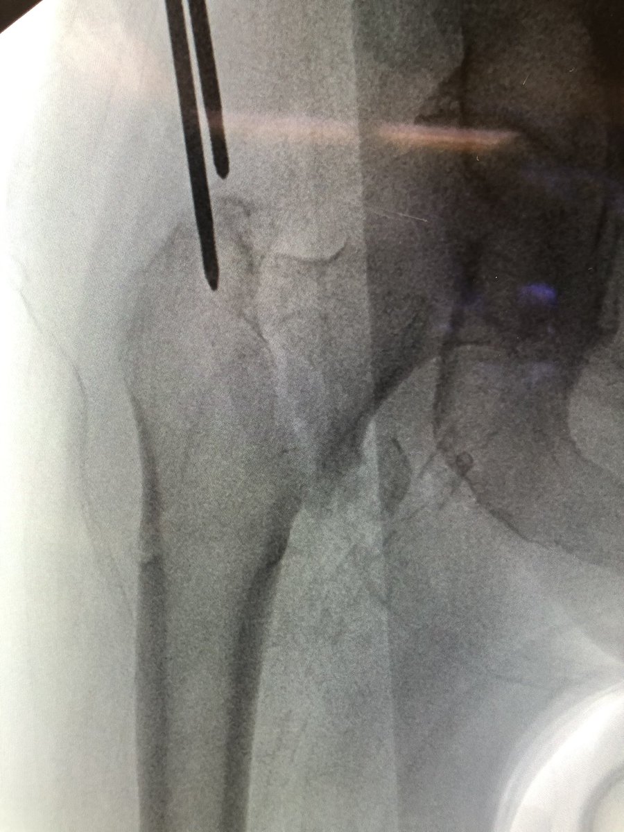 [6/18] If original start point isn’t good, I leave wire in so new wire doesn’t keep falling into same hole. Also I gently tap to get a foothold instead of using driver so that I can make minute redirections in either plane (yellow). ONLY when I’m happy, I extend stab incision.