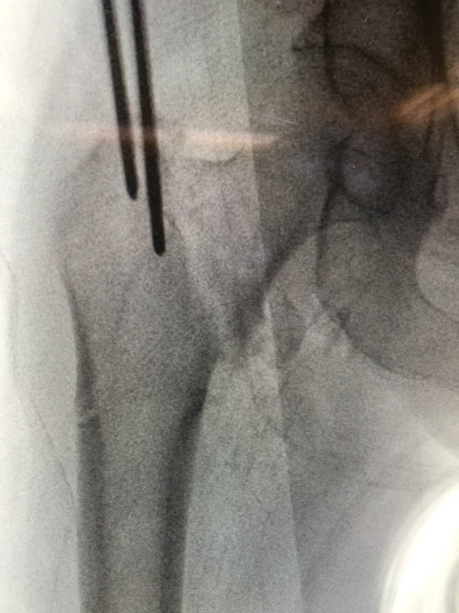 [6/18] If original start point isn’t good, I leave wire in so new wire doesn’t keep falling into same hole. Also I gently tap to get a foothold instead of using driver so that I can make minute redirections in either plane (yellow). ONLY when I’m happy, I extend stab incision.