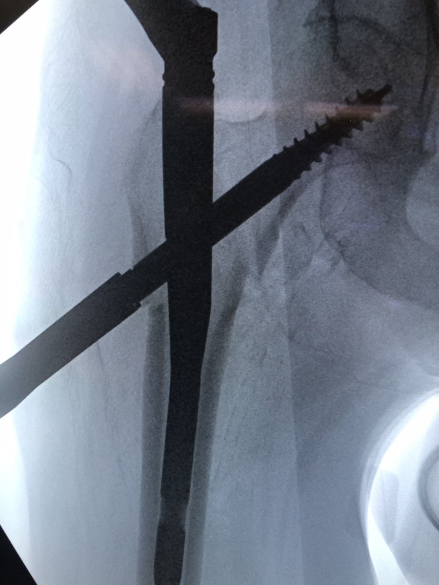 [15/18] I always try to build in some compression. The place to watch is the inferior medial portion of the fracture (arrow). Don’t overdo it or the nail starts to migrate medially.