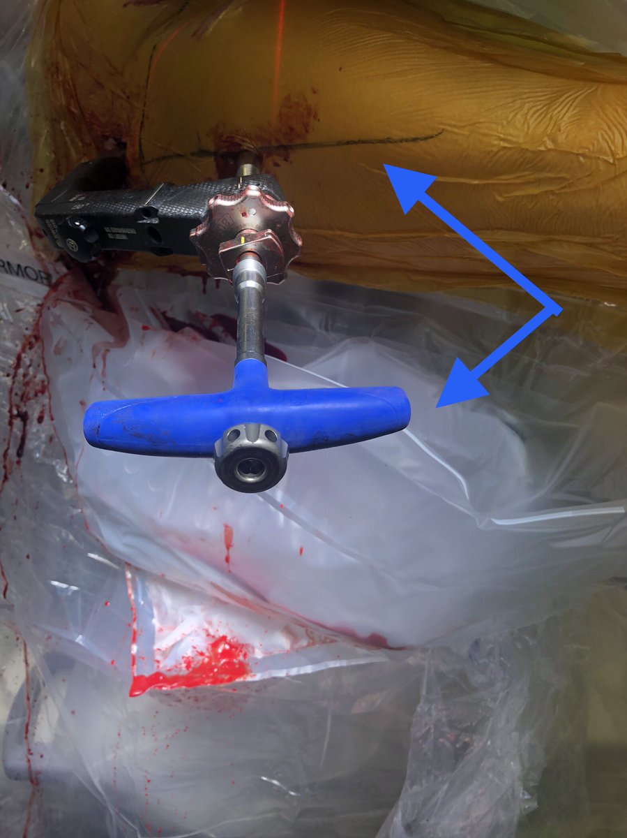 [14/18] If you line up screw handle with the line of the femur (blue) your screw end will be in the right plane. If it’s a left hip (clockwise screwing can flex the proximal fragment) I also build in an extra turn to derotate the proximal fragment if needed.