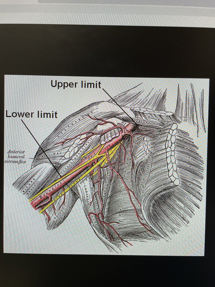 HadyLichaaMD's tweet image. Always Angio w 4F #Micropuncture sheath before #Ax #Largeboreaccess

@AntoniousAttall @payalkohlimd @sjgips @aelsab @Michel_CorbanMD @EmileMehanna @essadii @SamKMehta @fjsawaya @evhaddad @dimitri_zappi @gbiondizoccai @sbrugaletta @twj1974 @mmamas1973 @nickaram @crfheart @TCTMD