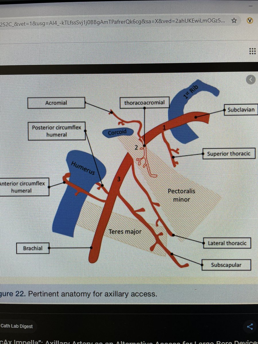 HadyLichaaMD's tweet image. Always Angio w 4F #Micropuncture sheath before #Ax #Largeboreaccess

@AntoniousAttall @payalkohlimd @sjgips @aelsab @Michel_CorbanMD @EmileMehanna @essadii @SamKMehta @fjsawaya @evhaddad @dimitri_zappi @gbiondizoccai @sbrugaletta @twj1974 @mmamas1973 @nickaram @crfheart @TCTMD