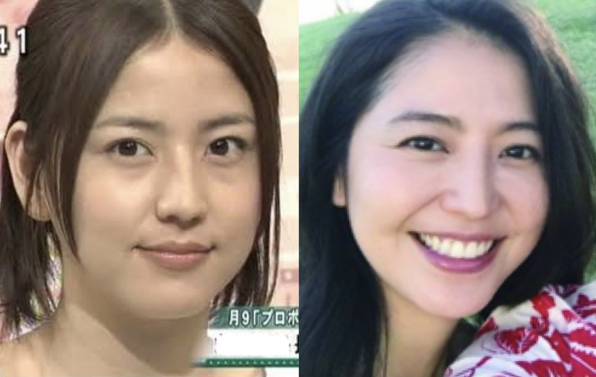 鷹ノ爪リリカ 10代の頃から長年悩まされた目の下のクマ 美容整形 してこんなにキレイになったよ たった30万 痛みゼロ ダウンタイム1週間 もっと早くやればよかった 指原さんも長澤まさみちゃんもクマ取ったら確実に綺麗になってる 悩んでる子にマジ 鷹ノ爪リリカ 10代の頃から長年悩まされた目の下のクマ 美容整形 してこんなにキレイになったよ たった30万 痛みゼロ ダウンタイム1週間 もっと早くやればよかった 指原さんも長澤まさみちゃんもクマ取ったら確実に綺麗になってる 悩んでる子にマジ