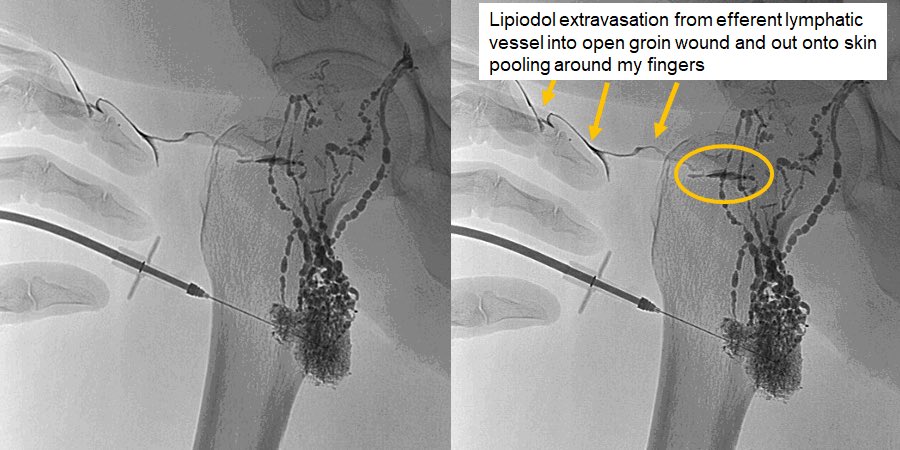 Waleska Pabon-Ramos, MD,MPH,FSIR (@wpabonramosmd) on Twitter photo Successful #Irad tx of groin lymphocele after failed drain, wound VAC, operation. Intranodal lymphangiogram & glue #embolization to the rescue! <a href="/DukeRadiology/">Duke Radiology</a> <a href="/DukeIR/">Duke IR</a> <a href="/SIRspecialists/">Society of Interventional Radiology</a> <a href="/SIR_ECS/">SIR ECS</a> <a href="/SIRRFS/">SIR RFS</a> <a href="/womenirads/">WomeninIR</a> Successful #Irad tx of groin lymphocele after failed drain, wound VAC, operation. Intranodal lymphangiogram & glue #embolization to the rescue! <a href="/DukeRadiology/">Duke Radiology</a> <a href="/DukeIR/">Duke IR</a> <a href="/SIRspecialists/">Society of Interventional Radiology</a> <a href="/SIR_ECS/">SIR ECS</a> <a href="/SIRRFS/">SIR RFS</a> <a href="/womenirads/">WomeninIR</a>