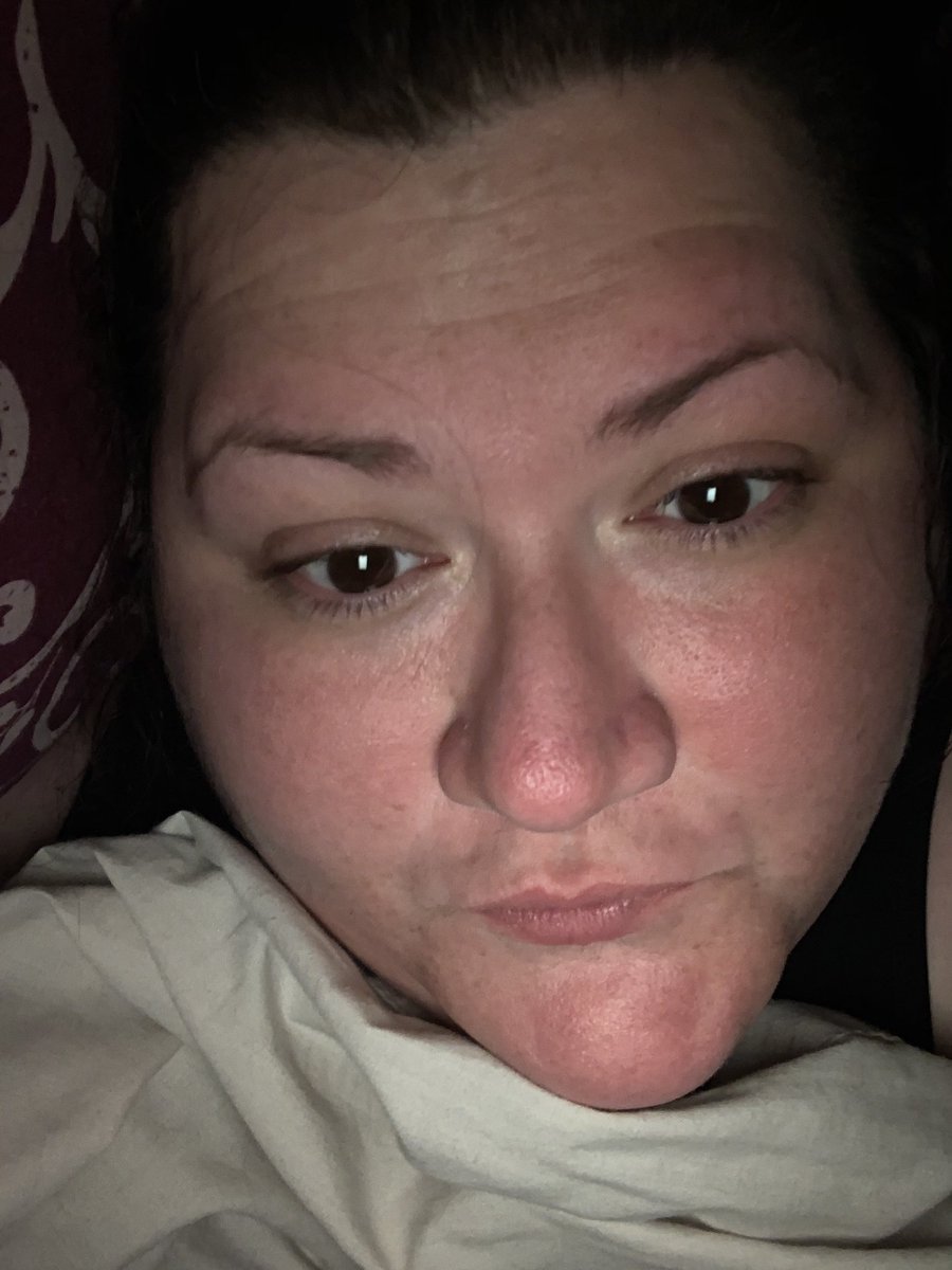 helen_a15's tweet photo. Feel rubbish today. Face I s swollen and flush. Itching like mad.
Think I’m gonna stay in bed.
#mastcelldisorder #hereditaryalphatryptasemiaSyndrome #chronicillness https://t.co/fucwCWPz6O