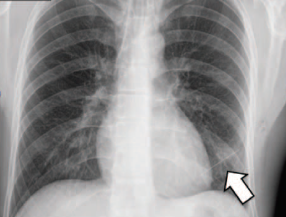Here's a chest X-ray that made the radiologist gasp and reach for the phone. What could this thin grey line possibly be? The patient was a 30 yo male, no significant medical history, who had started to experience stabbing pains in his chest a few days earlier.