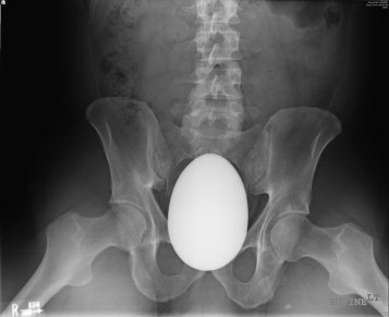 In desperation they consulted orthopaedics (!) and an ortho surgeon scrubbed in & divided the pubic symphysis, which was stretched open with a retractor to 4 cm. This gave enough space for the marble egg to be removed through the anus, using obstetric forceps. Phew!