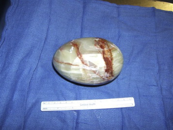 Here is this extraordinary foreign body, measuring 12x8x8 cm. It was a long and complicated surgical procedure but the patient made a full recovery and left hospital 4 days later.