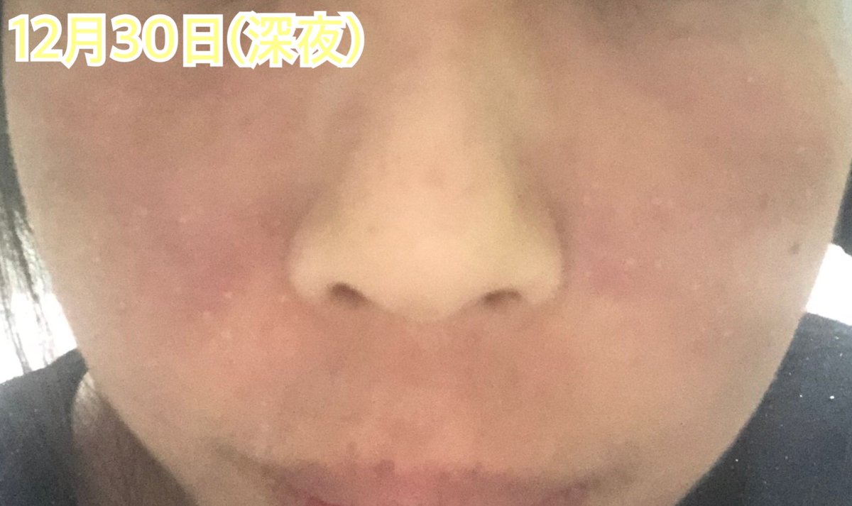 るいちゃん على تويتر 大した変化もなくパサパサと乾燥して赤みも健在 鼻に赤いポツポツが出現している 頬の保湿をやめたことで頬と小鼻の横が 皮むけするようになった 鼻の下もすごく悪くはないけどパサパサとまた少し小さめの鱗屑が付くようになった 一進一退