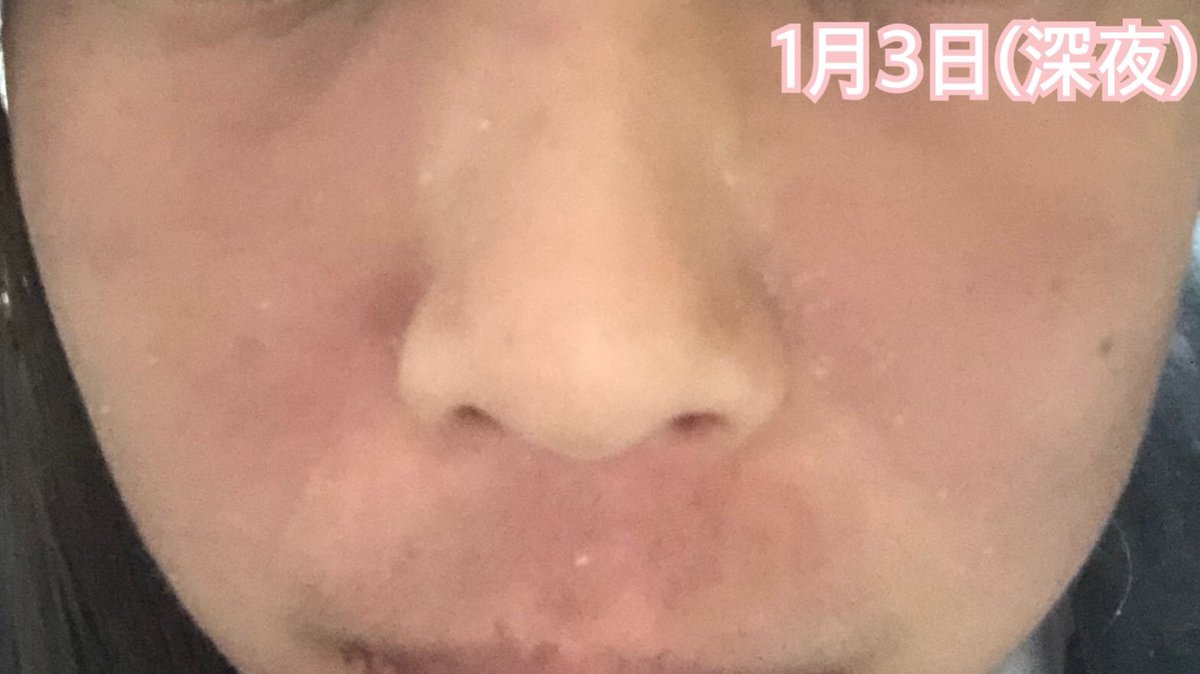 るいちゃん على تويتر 大した変化もなくパサパサと乾燥して赤みも健在 鼻に赤いポツポツが出現している 頬の保湿をやめたことで頬と小鼻の横が 皮むけするようになった 鼻の下もすごく悪くはないけどパサパサとまた少し小さめの鱗屑が付くようになった 一進一退